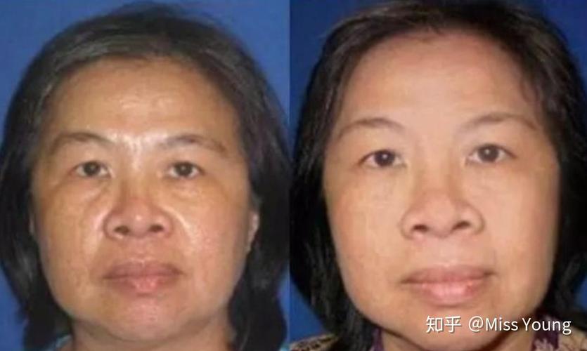 乌克兰干细胞中心中国有限公司_乌克兰干细胞注射价格表_乌克兰干细胞治疗恢复期