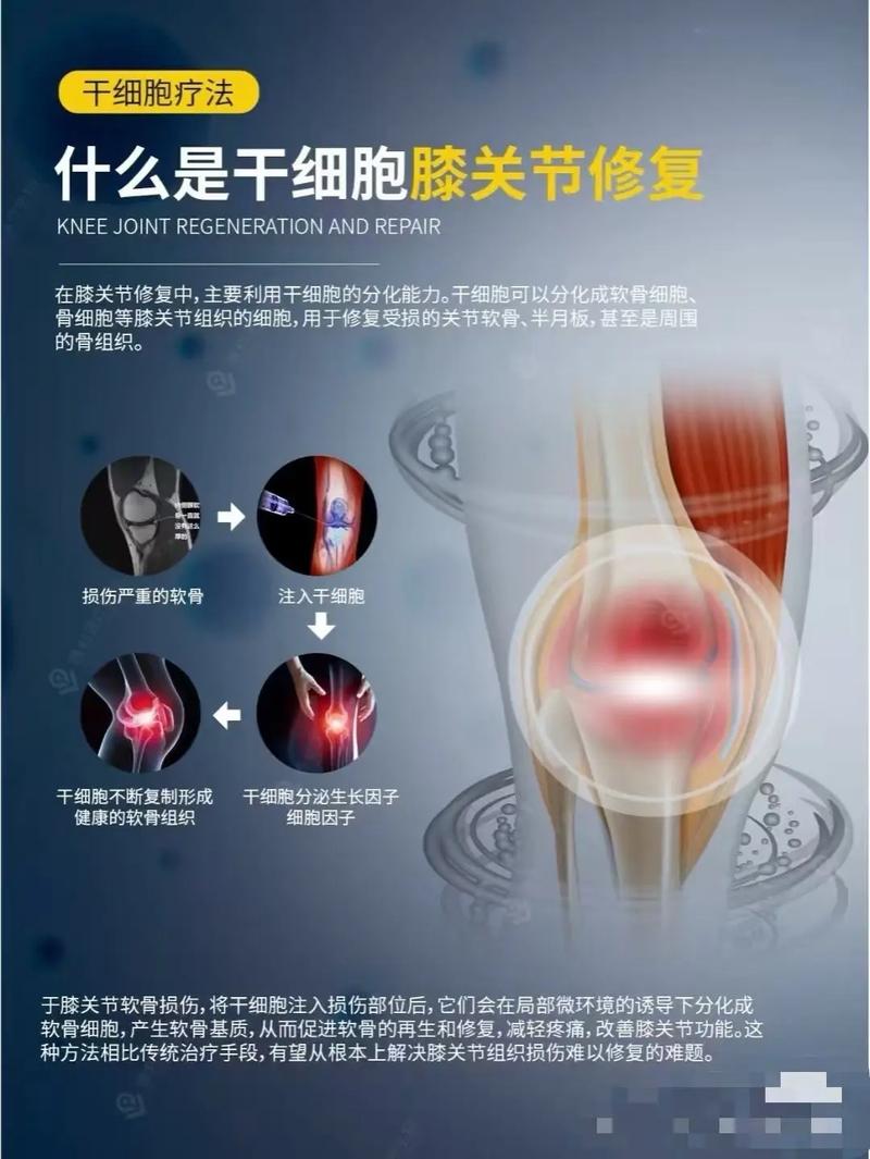 泰国干细胞关节炎_细胞治疗关节炎_关节炎干细胞