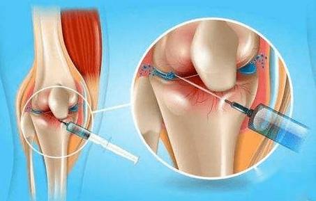关节炎干细胞_膝关节炎干细胞治疗_泰国干细胞关节炎