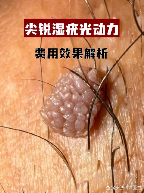 滋尔滨细胞美疗靠谱吗_泰国干细胞治疗靠谱吗_沈阳治疗尖锐湿疣价格靠谱皇嘉