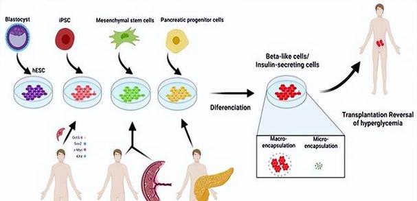 日本干细胞治疗糖尿病_细胞疗法治糖尿病_日本干细胞治疗糖尿病研究进展