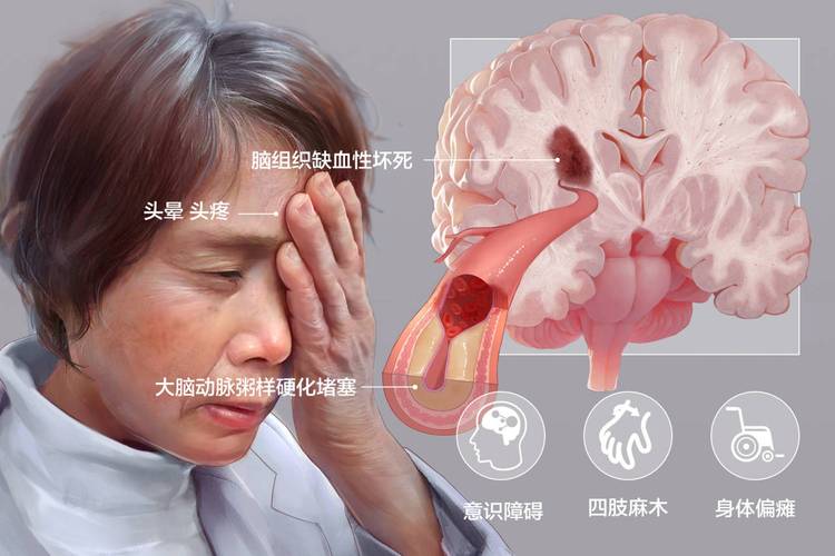 民间偏方治疗脑梗的_急性脑梗最佳治疗时间_格鲁吉亚干细胞治疗脑梗后遗症