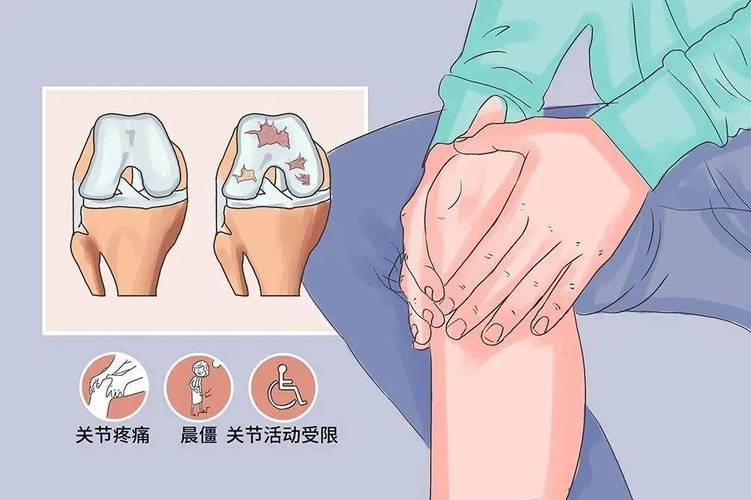 日本干细胞治疗关节炎_骨关节炎干细胞治疗_关节炎干细胞