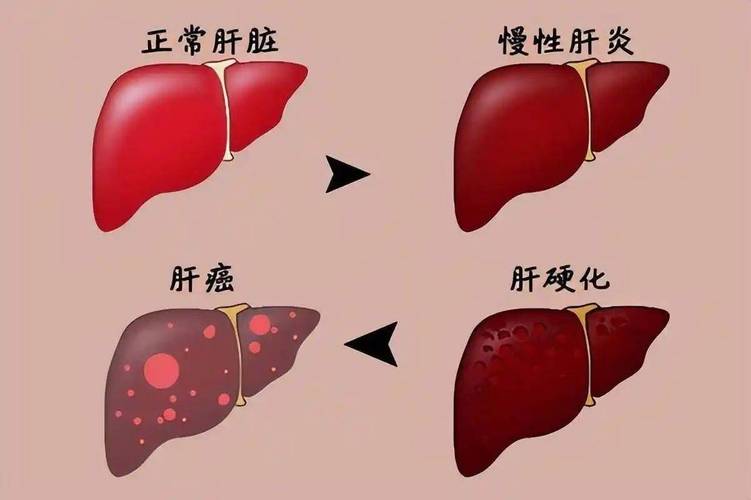 肝硬化干细胞治疗成功_日本干细胞治疗肝硬化_肝硬化细胞疗法