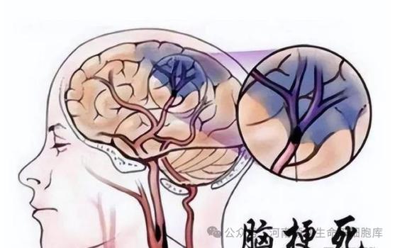 泰国干细胞治疗脑梗后遗症_治疗脑梗_脑梗大小便失禁治疗