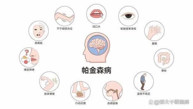 泰国干细胞帕金森治疗_国外干细胞治疗帕金森_泰国细胞治疗干帕金森的药