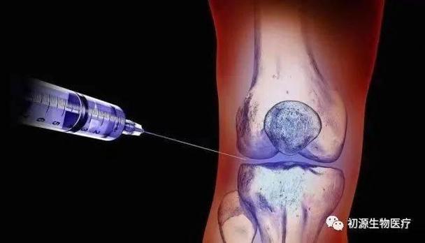 膝关节细胞疗法_德国干细胞治疗膝关节炎_膝关节炎与干细胞治疗