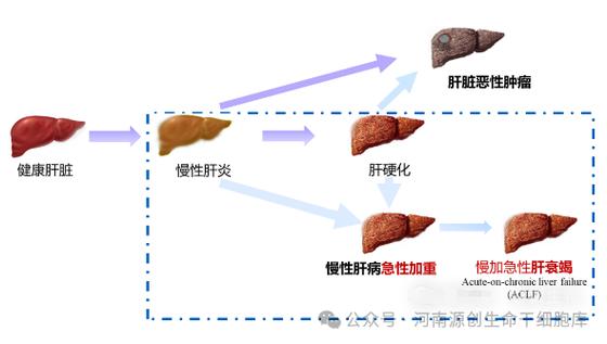 德国干细胞治疗肝硬化_肝硬化干细胞疗法_干细胞疗法治疗肝硬化费用