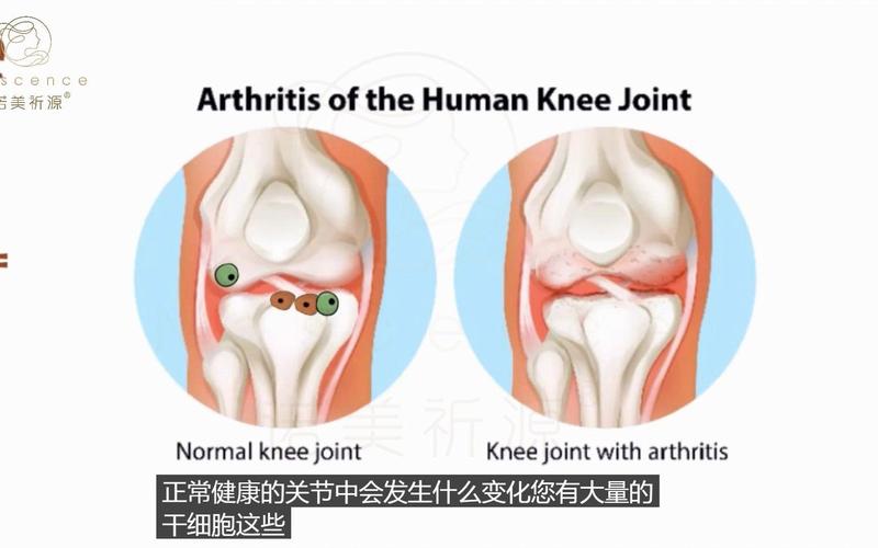 干细胞治疗关节多少钱_干细胞治关节成功的案例_日本干细胞关节治疗价格