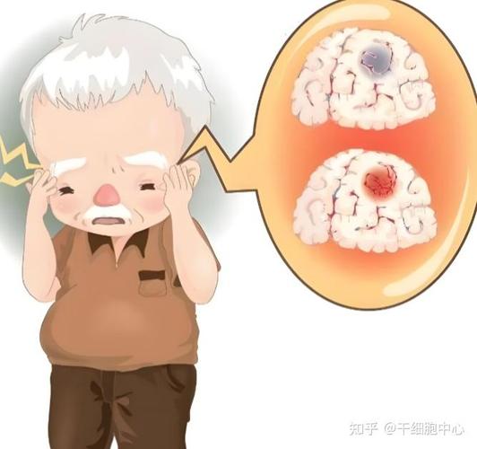 美国干细胞治疗脑梗_美国干细胞治疗脑卒中_干细胞治愈脑梗