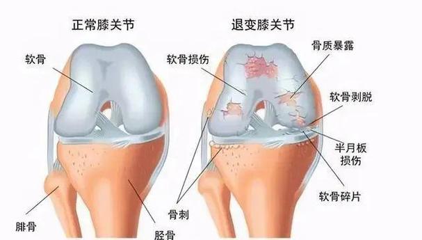 泰国治疗关节炎的药膏_泰国干细胞治疗关节炎_泰国关节炎的药哪种好